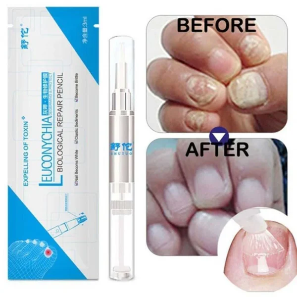 Nail Fungal Treatment Pen Anti Fungus Infection Biological Repair Solution